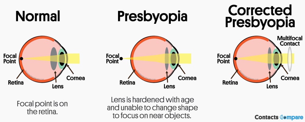 presbyopia diagram