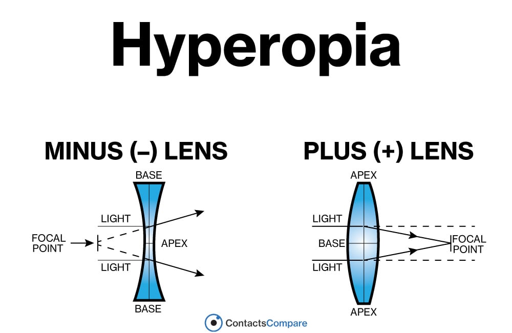 hyperopia diagram with plus and minus lenses